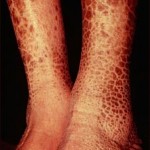 Ictiosis laminar