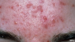 Normalmente, la frente forma parte de la zona llamada T, que incluyen también la nariz y el mentón.